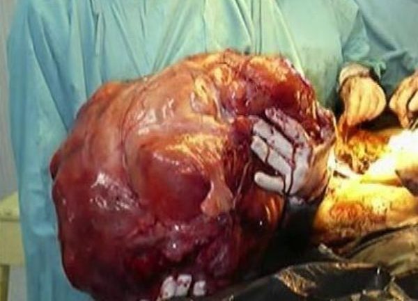 Tumor težak 23 kilograma
