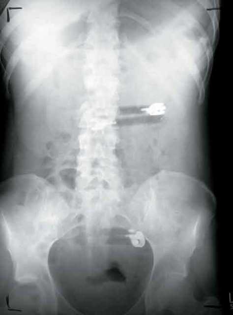 Droga u organizmu, ilustracija