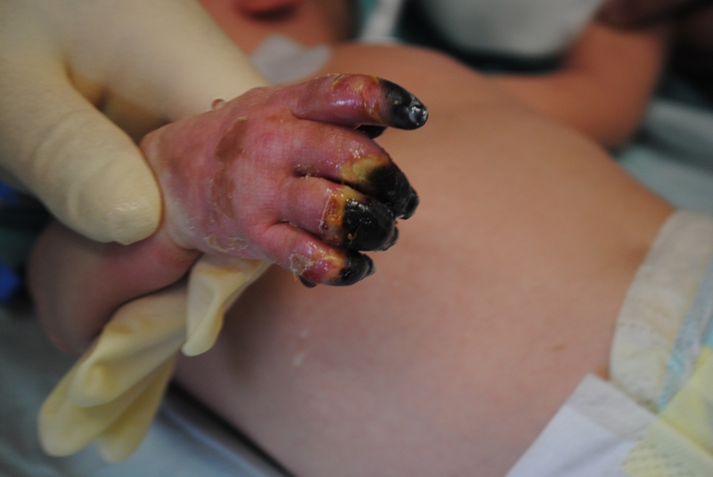 Ališan Omerspahić boluje od teškog oblika sepse Ališan Omerspahić boluje od teškog oblika sepse