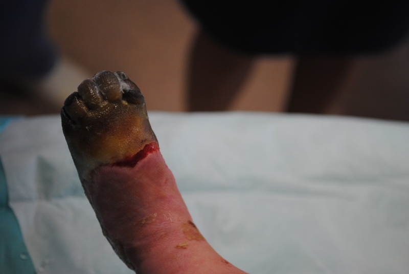 Ališan Omerspahić boluje od teškog oblika sepse Ališan Omerspahić boluje od teškog oblika sepse