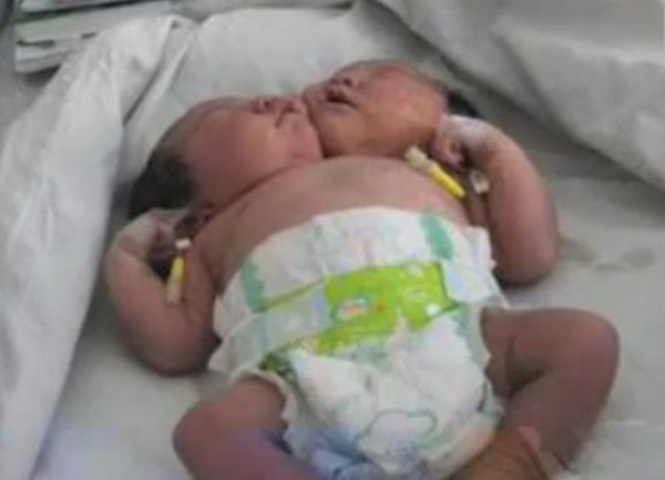 Beba s dvije glave rođena u Kini