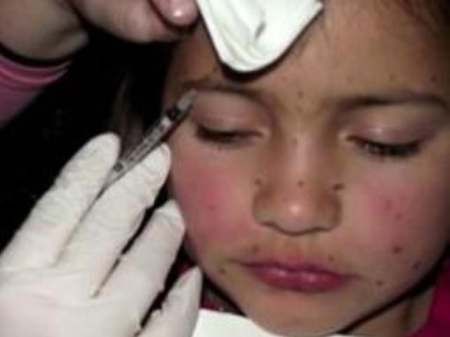 Injekcije botoksa se ubrizgavaju djetetu