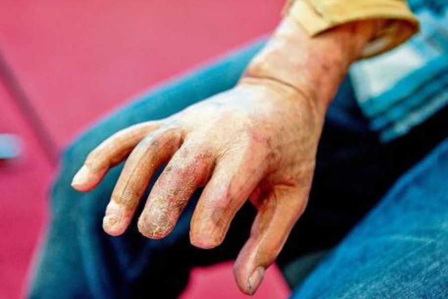 ljubomorna djevojka spržila mu&scaron;karca1