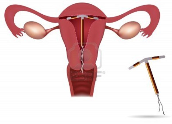 spirala kontracepcija