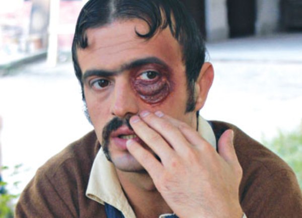 Sergej Trifunović sa &scaron;ljivom na oku