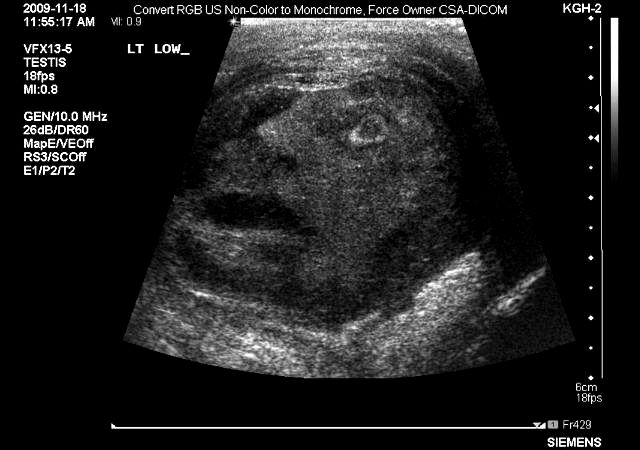 Tumor sa ljudskim likom Tumor sa ljudskim likom