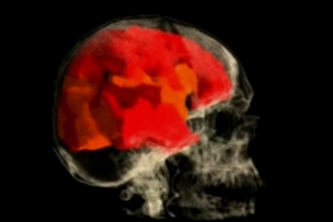 Snimak mozga Snimak mozga