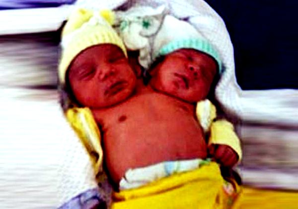 Rođena dvoglava beba u Brazilu