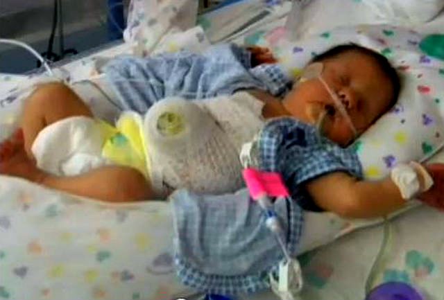 Beba rođena sa organima van tijela