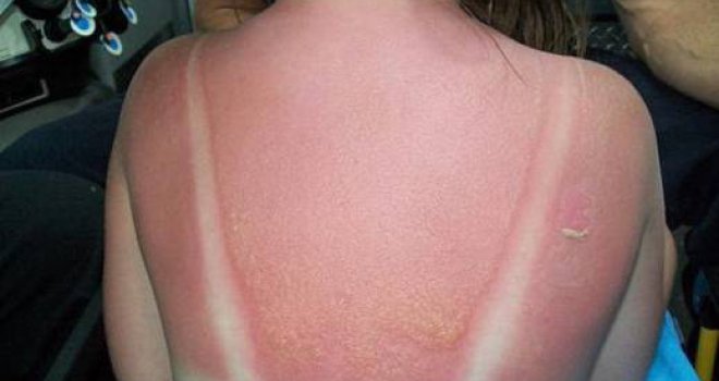 Opekotine od sunca nisu šala, evo kako vas mogu dovesti do melanoma: Ne ljuštite površinski sloj kože...