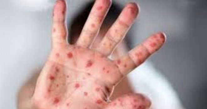 Epidemija ne jenjava, nevakcinisani imaju razloga za strah: U KS čak 363 osobe oboljele od morbila!