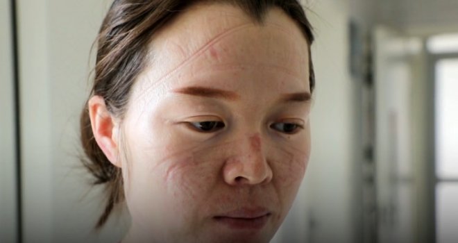 Kineski medicinski radnici naporno rade, maske im se urezale u lice