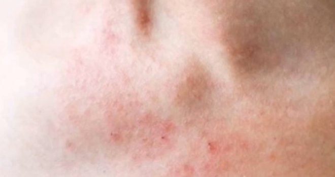 'Ovo je najgori proizvod za kožu svih vremena, izaziva grozne reakcije': Poznati dermatolog upozorava na posljedice